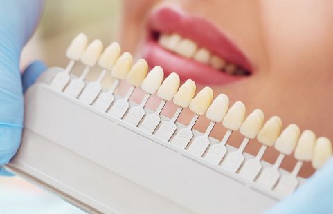 Bọc răng sứ có hại không là thắc mắc của không ít người có nhu cầu.