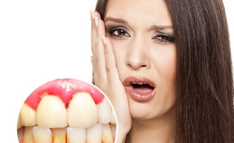 Răng bọc sứ bị chảy máu có thể do viêm nướu