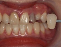 Bọc răng sau khi lấy tủy để tăng tính thẩm mỹ cho hàm răng