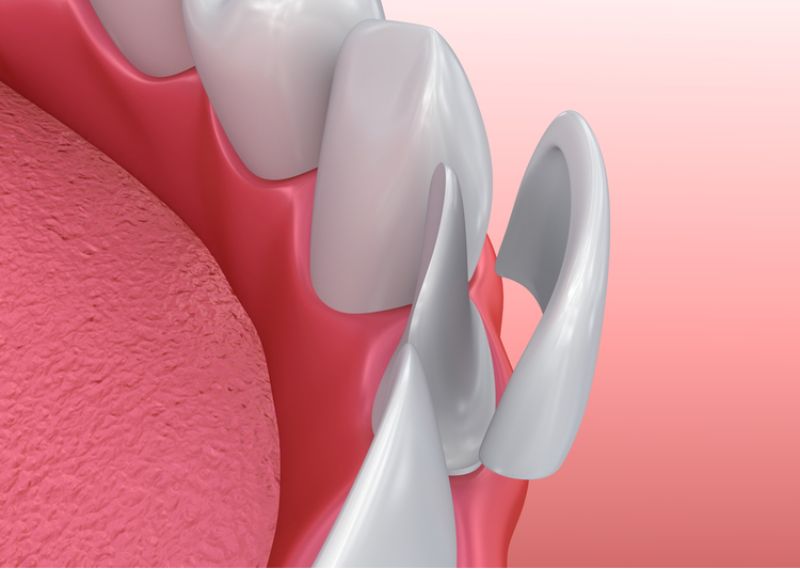Những biến chứng có thể gặp phải khi bọc răng sứ