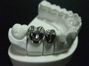 Bọc răng bạc là gì? Quy trình, chi phí và một số lưu ý khi thực hiện