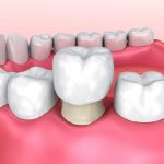 Bọc răng hàm và những điều cần biết trước khi thực hiện