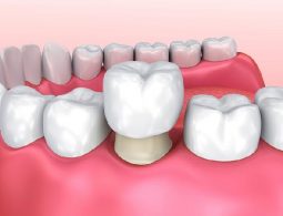 Bọc răng hàm và những điều cần biết trước khi thực hiện