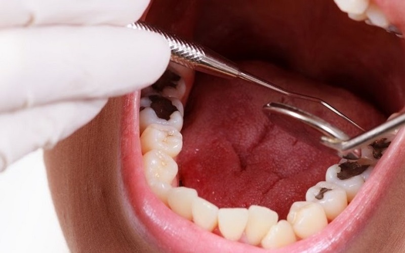 Mức độ sâu răng ảnh hưởng đến giá tiền bọc răng
