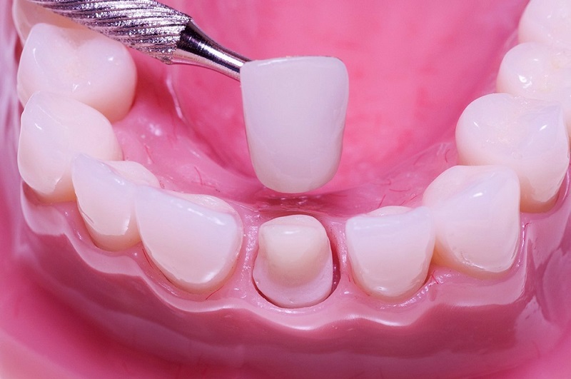 Bọc răng sứ có đau không là thắc mắc của nhiều độc giả