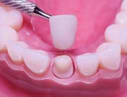 Giải đáp bọc răng sứ giá bao nhiêu? Các yếu tố ảnh hưởng