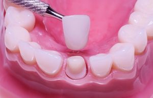 Giải đáp bọc răng sứ giá bao nhiêu? Các yếu tố ảnh hưởng