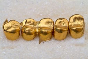 Bọc răng vàng là gì? Phương pháp bọc răng xa xỉ này có ưu và nhược điểm gì?