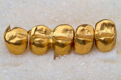 Bọc răng vàng là gì? Phương pháp bọc răng xa xỉ này có ưu và nhược điểm gì?