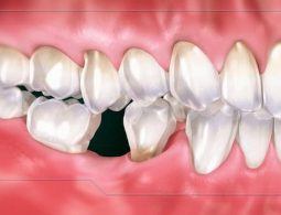Tình trạng mất răng liệu có tự mọc được không là thắc mắc của nhiều người
