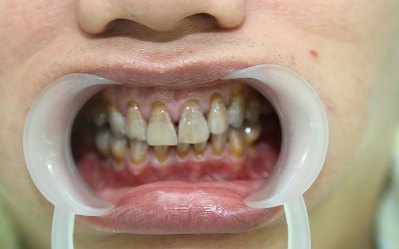 Khi răng bị nhiễm màu nặng, khó tẩy trắng bạn nên bọc răng sứ thẩm mỹ