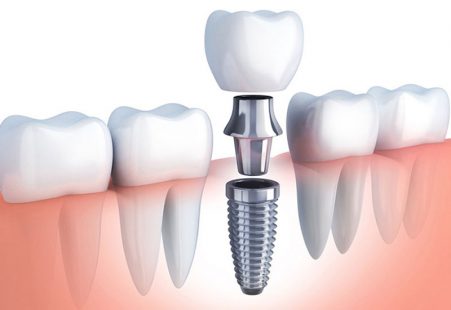 Trồng răng giả là phương pháp phục hình răng miệng có nhiều ưu điểm nhất định