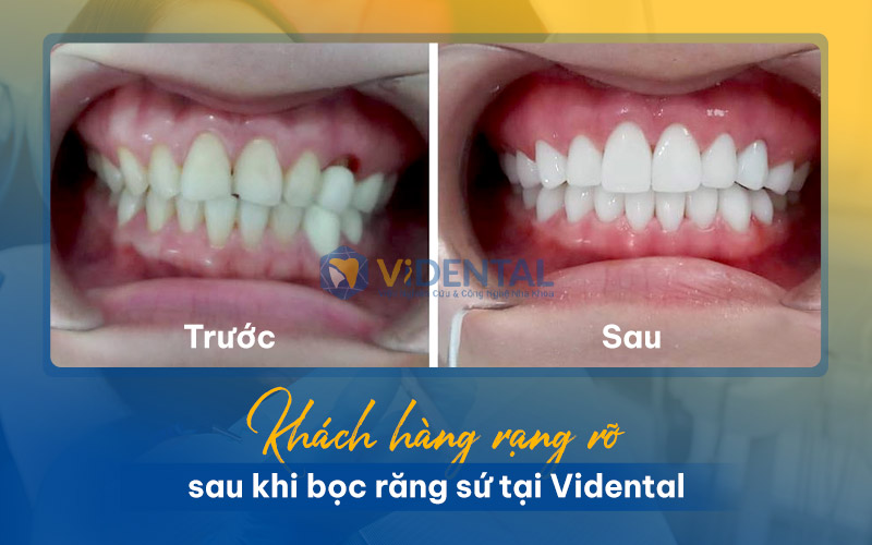 Hình ảnh khách hàng sau khi bọc răng sứ, khắc phục tình trạng răng khấp khểnh, không đều