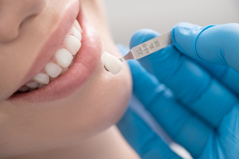 Bọc răng sứ cercon giá bao nhiêu phụ thuộc vào nhiều yếu tố khác nhau