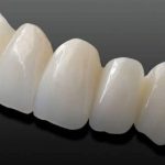 Bọc răng sứ cercon giá bao nhiêu, nên bọc loại nào và bọc ở đâu?