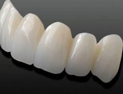 Bọc răng sứ cercon giá bao nhiêu, nên bọc loại nào và bọc ở đâu?