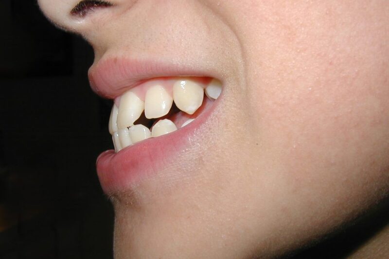 Bọc sứ được áp dụng cho những trường hợp răng hô ít