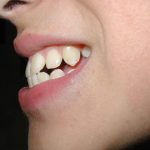 Phương pháp bọc răng sứ cho răng hô giá bao nhiêu? Quy trình và địa chỉ thực hiện hiệu quả