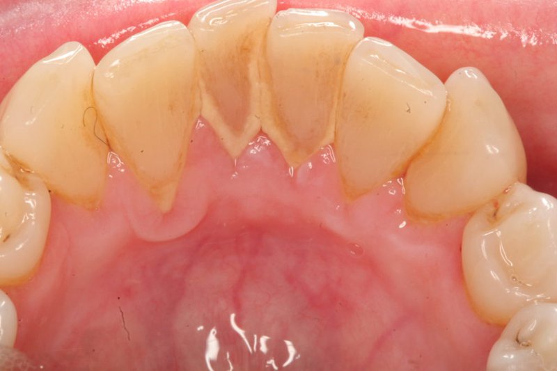 Có nhiều nguyên nhân khác nhau dẫn đến việc hình thành vôi răng