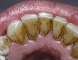 Cao răng là gì? Giải pháp loại bỏ và phòng ngừa hiệu quả