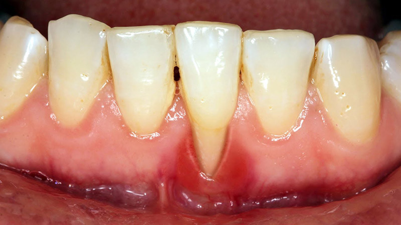 Tụt nướu hay viêm nướu là các bệnh lý răng miệng dạng nhẹ