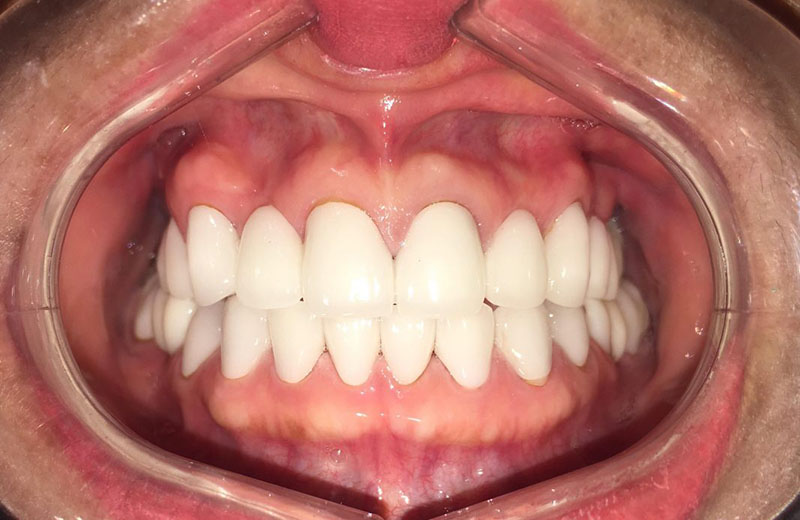 Nướu răng là gì? Nướu răng là một phần của niêm mạc miệng