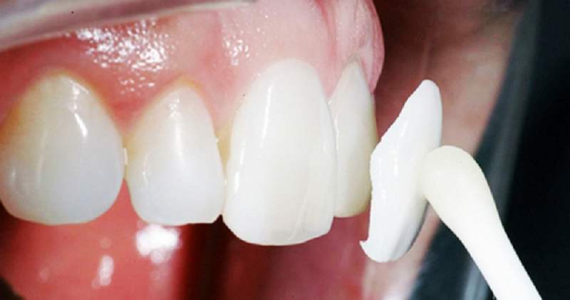 Dán sứ veneer giúp khắc phục tình trạng răng cửa bị thưa hiệu quả