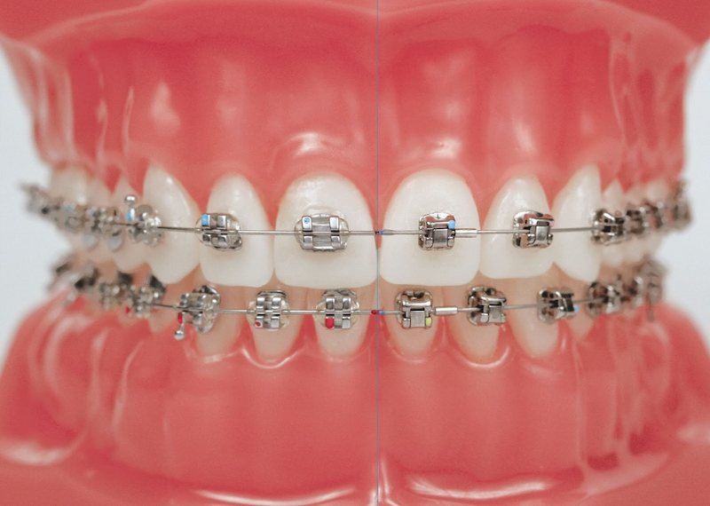 Niềng răng chỉnh nha giúp khắc phục tình trạng răng thưa