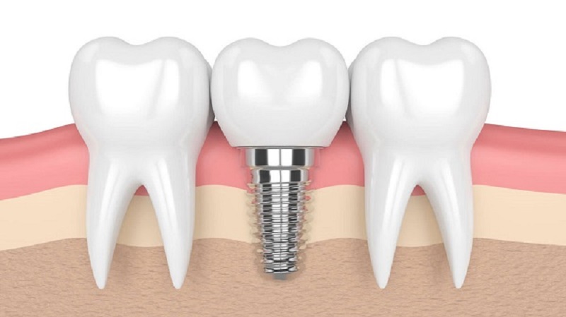 Trồng răng bằng răng Implant