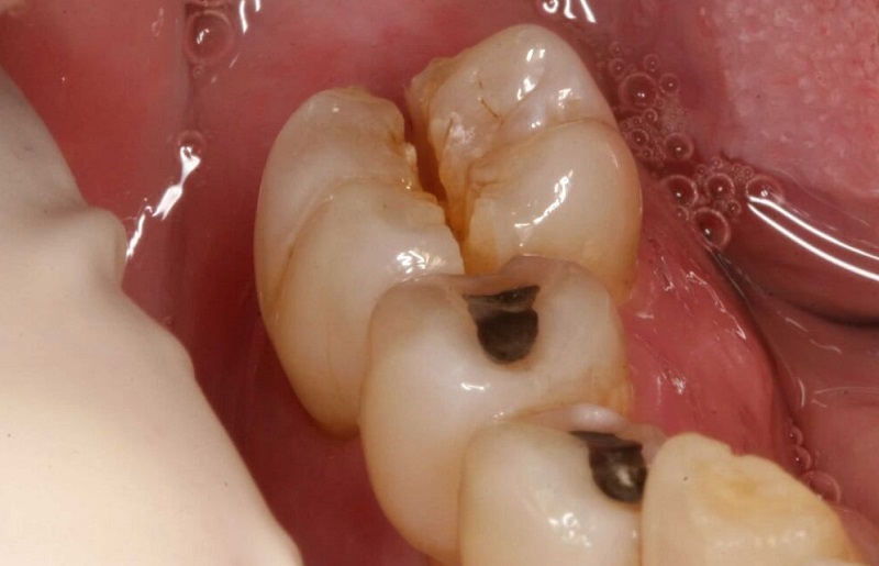 Răng hàm nằm ở phía trong của hàm răng