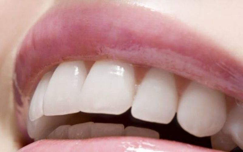 Bọc sứ cho răng hô giúp bạn sớm sở hữu hàm răng đẹp như ý muốn