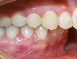 [Chuyên gia giải đáp]: răng hô có nên bọc sứ hay không?