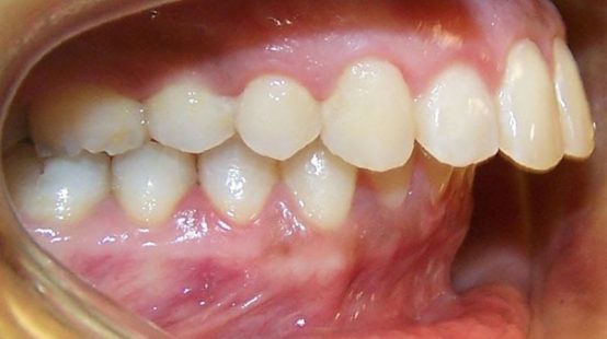 [Chuyên gia giải đáp]: răng hô có nên bọc sứ hay không?