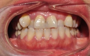 Răng khấp khểnh có nhiều nguyên nhân khác nhau