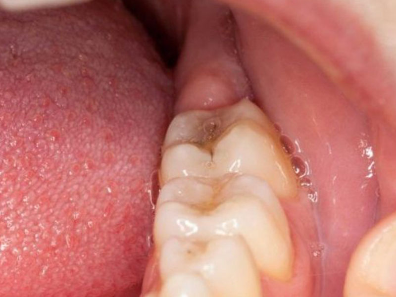 Viêm lợi trùm, viêm nướu là biến chứng thường gặp do răng khôn gây ra