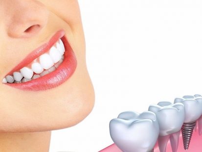 Trồng răng implant: 5 điều cần biết trước khi thực hiện