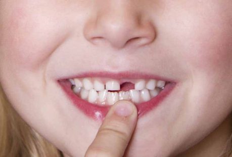 Nhổ răng sữa bao lâu mọc lại? Hướng dẫn chăm sóc trẻ sau nhổ răng đúng cách