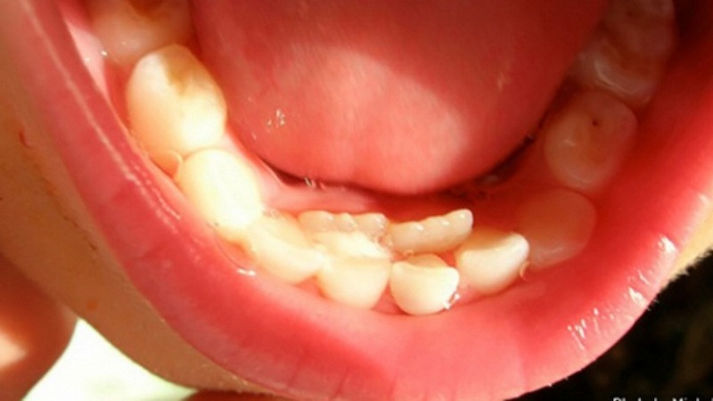 Có nhiều nguyên nhân khác nhau dẫn đến răng sữa mọc lệch
