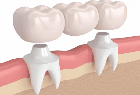 Quy trình trồng răng sứ thế nào là chuẩn nhất?