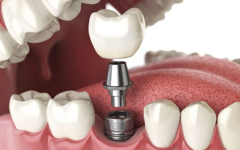 Trồng răng giả cố định implant là lựa chọn của nhiều khách hàng