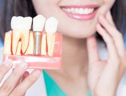 Trồng răng sứ cố định là gì? Ưu, nhược điểm và chi phí thực hiện mới nhất