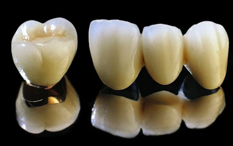 Răng sứ kim loại thường có giá rẻ nhưng nhiều nhược điểm