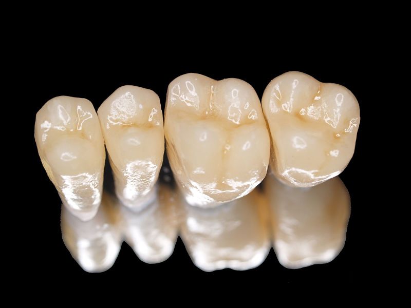 Răng sứ kim loại titan được ưa chuộng hơn kim loại thường