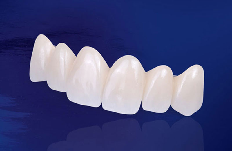 Khi tìm hiểu trồng răng sứ loại nào tốt nhất, răng toàn sứ Zirconia là lựa chọn hấp dẫn