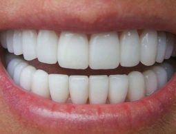Trồng răng sứ nguyên hàm - 6 điều cần biết trước khi thực hiện