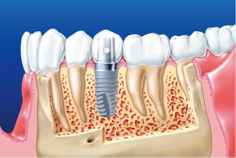 Cấy ghép implant có thời gian thực hiện lâu hơn cầu răng sứ