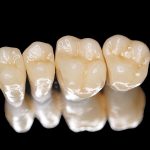 Trồng răng sứ titan - Giải đáp 5 thắc mắc thường gặp