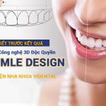 Công nghệ Thiết kế nụ cười V.Smile Design tại ViDental