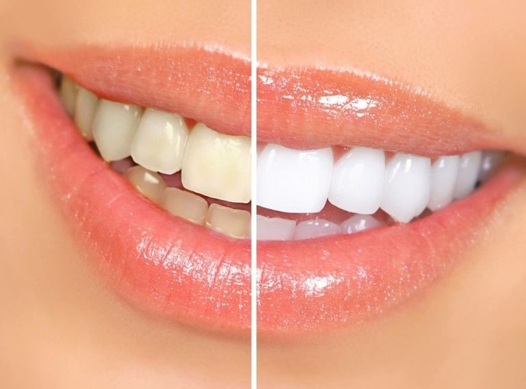 Tẩy trắng răng ở đâu tốt phụ thuộc vào nhiều yếu tố