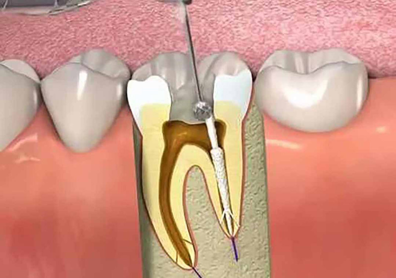 Mở tủy răng và loại bỏ phần tủy bị viêm